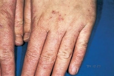 Eldeki Güneş Lekeleri Nasıl Geçer?