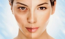 Yüzdeki Güneş Lekeleri Nasıl Geçer?