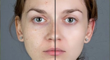 Kahverengi Güneş Lekeleri Nasıl Geçer?