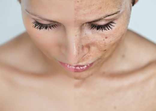 Güneş Lekeleri İçin Doğal Maske