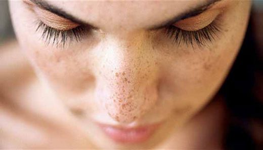 Güneş Lekeleri Lazer Tedavisi